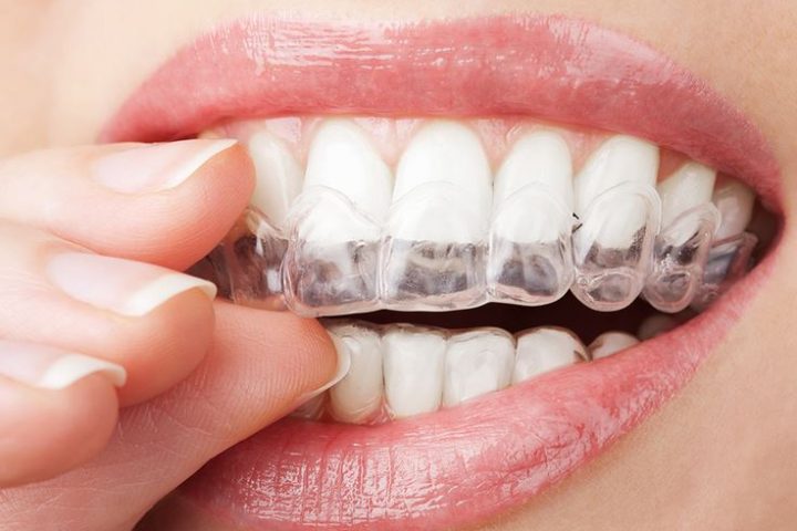 Want A Straight Smile? How To Find The Right Orthodontist