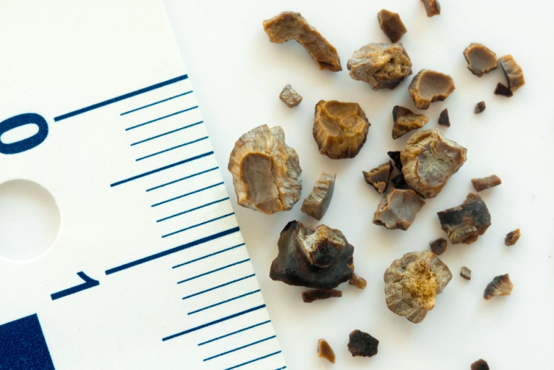 10 Signs And Symptoms Of Kidney Stones
