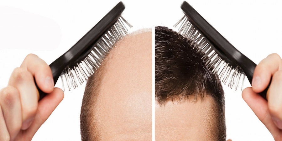 Redefine Your Looks With Hair Transplant In Dubai